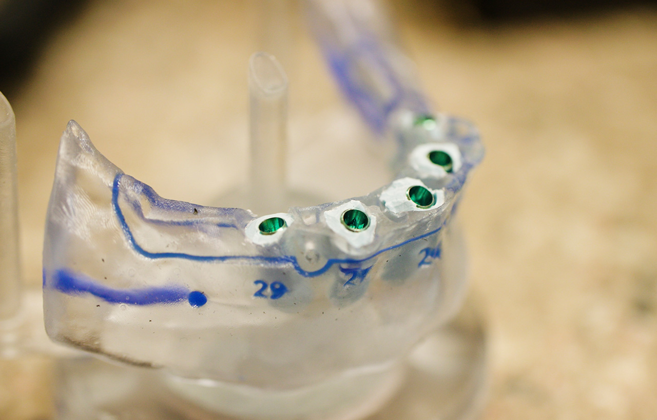Jacksonville FL Dental Implant Dentists